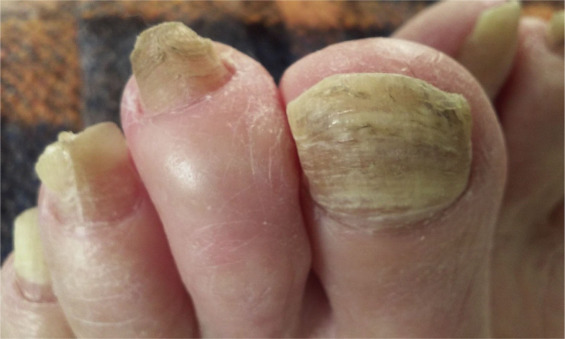 Nail Fungus