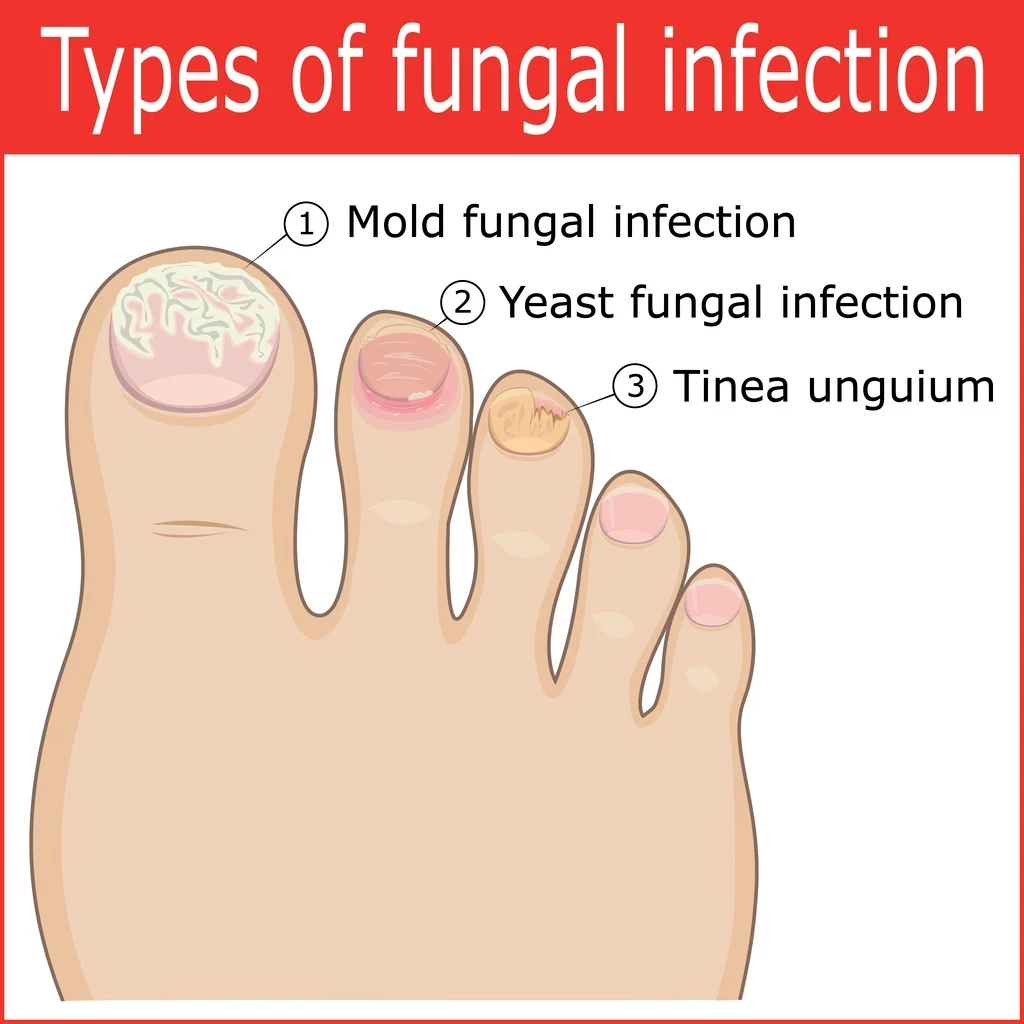 best for nail fungus