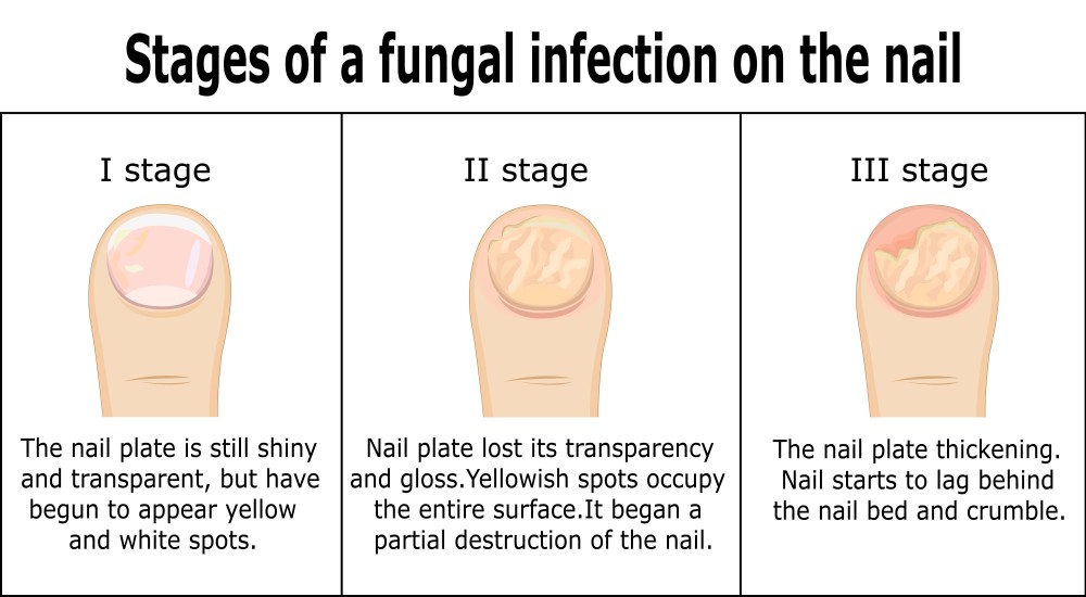 best for nail fungus